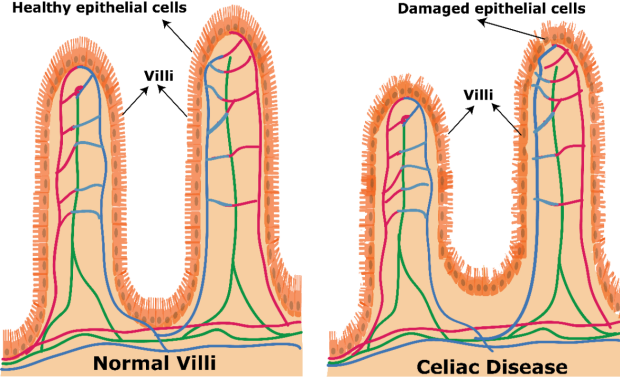healthy epithelial cells vs damaged epithelial cells